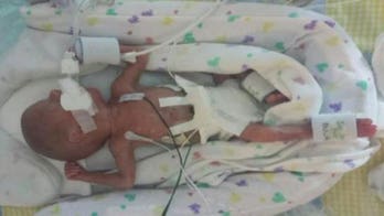 Identical twin slated to be delivered 4 months after brother in rare birth