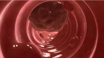 Hormone loss may be involved in colon cancer, study says