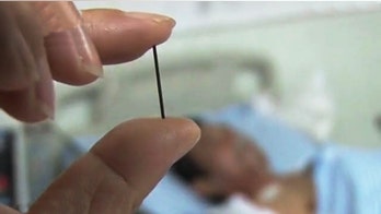 Docs remove acupuncture needle lodged in Chinese man’s stomach for 40 years