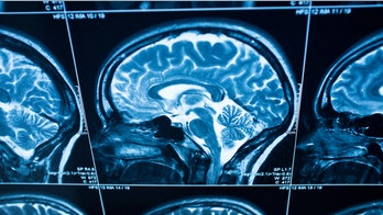 MS patients’ symptom severity linked to gray matter myelin loss