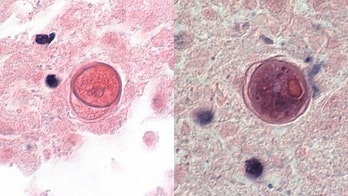 After losing daughter, California mom vows to raise awareness of deadly amoeba