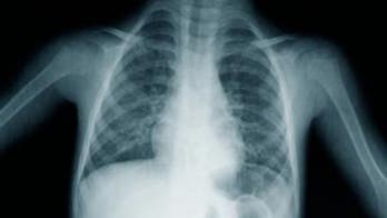 Lung cancer CT scans: Just for older heavy smokers