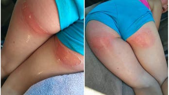 Missouri mom warns about danger of hot slides after girl, 4, suffers second-degree burns