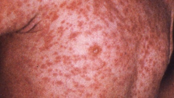 N.J. Restaurant Patrons May Have Been Exposed to Measles