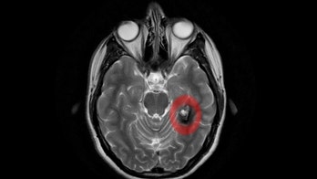Brain tumor triggers woman's sudden 'hyper-religious' behavior