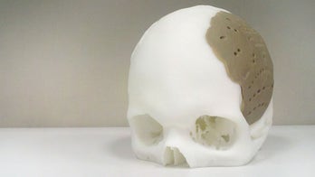 3D-printed skull implant ready for operation