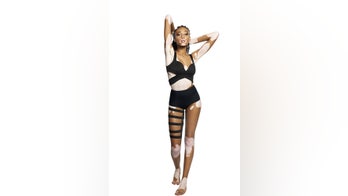 20-year-old gal makes a splash as 'America's Next Top Model' contestant with skin condition