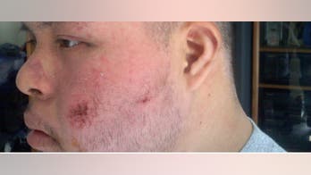 Latino with Down Syndrome Beaten by Cops, Family Says