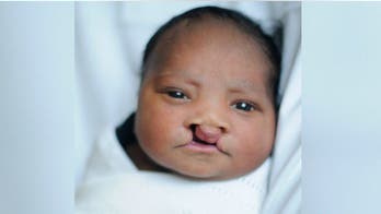 Newborn undergoes surgery for bilateral cleft palate in time for Christmas