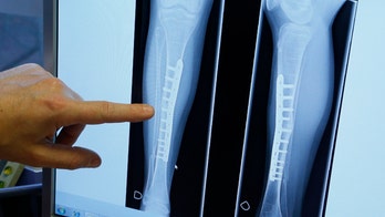 Toddler born without a tibia thriving after receiving prosthetic leg