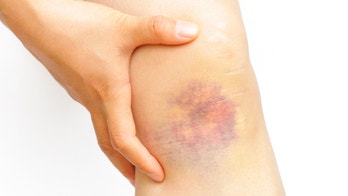7 odd reasons you bruise easily