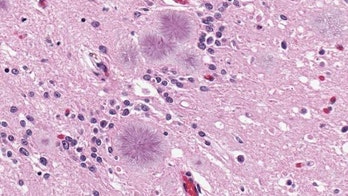 Fatal brain disease in US man likely came from UK beef