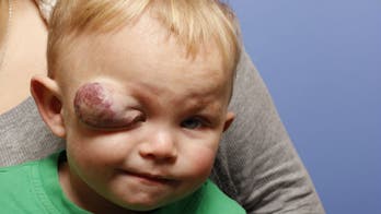 Volunteer surgeons in NYC remove toddler’s vision-threatening tumor