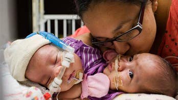 Conjoined twin girls successfully separated in Texas