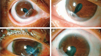 'Corneal melt': Arthritis complication lets woman's iris slip out