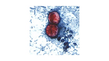 Cyclospora outbreak spreads to Texas