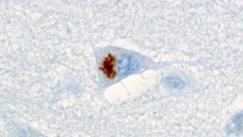 Mysterious brain clumps behind dementia identified