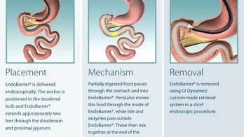 New implantable device helps diabetics control blood sugar, lose weight