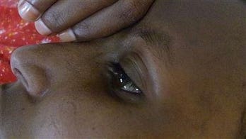 Teenage Brides Suffer Pain, Shame of Fistula