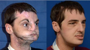Face transplants should be offered to more patients, doctors say