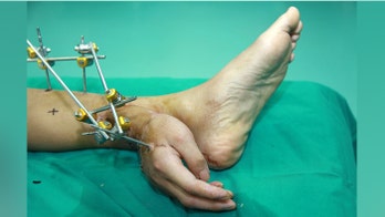 Doctors save man's severed hand by sewing it to his ankle