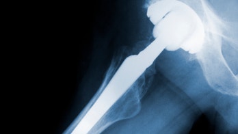 Doctors urge against metal hip joints