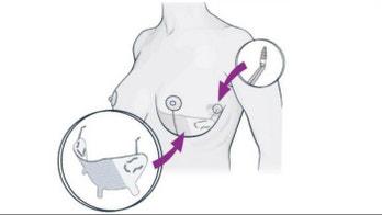 Controversial ‘internal bra’ procedure promises a longer lasting breast lift