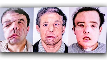 Man left faceless for 2 months undergoes second transplant after first deteriorates