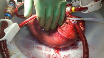 Device keeps liver 'alive' outside body in medical first