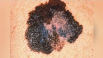 Newly discovered biomarker can better guide treatment for melanoma patients