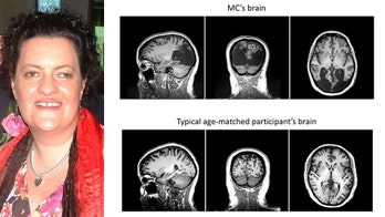 Doctors reveal rare condition that causes blind woman, 48, to only see moving objects