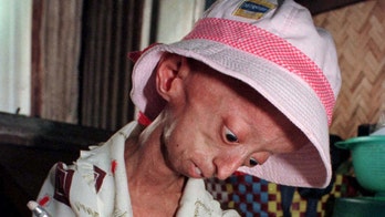 Study of rare disease progeria helps in search for clues on aging