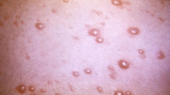 UPDATE: FDA OKs Shingle Vaccine for Those Aged 50 to 59