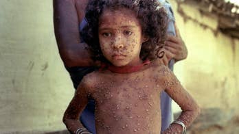 135-Year-Old Piece of Skin Triggers Smallpox Scare at Museum