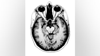 Spiders, Snakes? Brain-Damaged Woman Knows No Fear