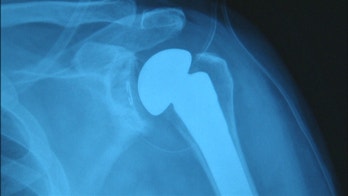 5 fixes for achy joints