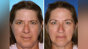 Smokers' skin may age faster, study of twins shows