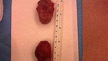 Man's Freakishly Giant Tonsils Break World Record