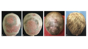 Arthritis drug allows hairless man with alopecia to grow hair