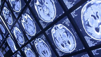 MRI scan may help prevent ADHD misdiagnosis