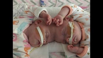 Formerly conjoined twins thriving after separation surgery