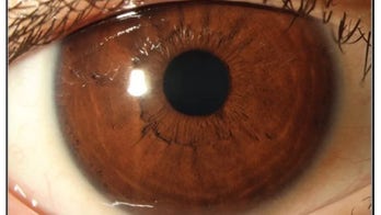 Diet of lamb and Cheerios leads to boy's vision loss