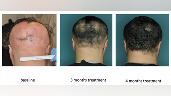 Researchers find 'miracle cure' for baldness