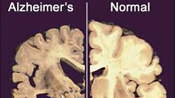 Researchers testing stem cells to treat Alzheimer's in first-of-its-kind trial