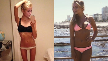 Amalie Lee documents recovery from anorexia on Instagram