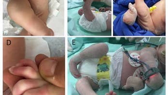 Dr. Manny: The battle against Zika does not end with microcephaly