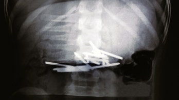 Boy recovering after swallowing 12 nails that punctured his organs