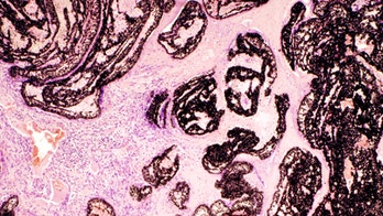 Astronomy algorithms help detect aggressive cancers