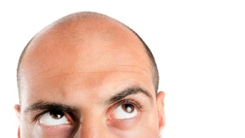 Research suggests being short and white may raise your risk of going bald