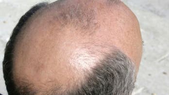 Man’s heavy metal poisoning leads to vision loss, baldness